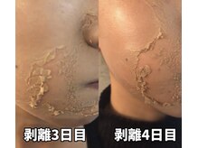 カン コルギセラピー 横浜(KAN)の雰囲気（肌の真皮までハーブがマイクロハリに変わって刺激。韓国で大人気）