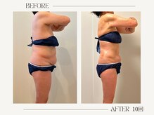 シーアンル(C.aneL)/施術ビフォーアフター10回