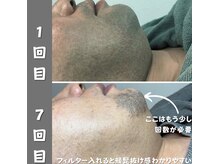 ベール(BEHL)/BEHLの髭脱毛！