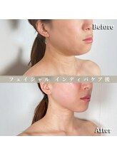 術後の女神 大阪心斎橋店/術後ケアインディバ・インディバ