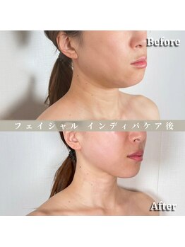 術後の女神 大阪心斎橋店/術後ケアインディバ・インディバ