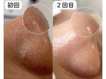 アンビワン(Anbione.)/毛穴エクストラクションプロ