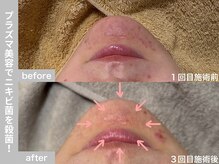 サロン ビュー(salon view)/30代女性〈ニキビ悩み〉　