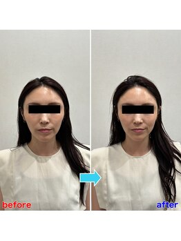 フロー鍼灸整体院(FLOW鍼灸整体院)/美容鍼 ビフォーアフター