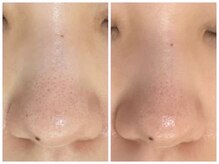 ホリシア 博多(HORISHIA)/ハーブピーリング/ニキビケア