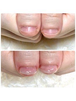 ココモ(cocomo)/深爪/自爪育成/フィルイン