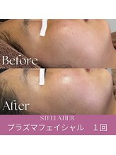ステラティエ(Stellatier)/ニキビ/乾燥肌/肌荒れ/赤み
