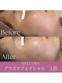 ステラティエ(Stellatier)/ニキビ/乾燥肌/肌荒れ/赤み