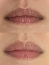 ドクターメラニン ラボ トーキョー 渋谷(Dr. Melanin Labo TOKYO)/唇メラニンケア症例
