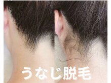 バーム(BAAM)/うなじ脱毛