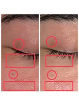 エステティック アントワネット/高濃度水素LEAP+ララピール1回