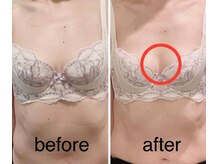 ベッピン(Beppin)/バストアップ症例写真
