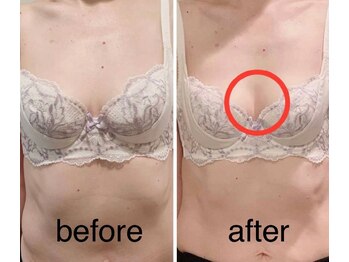 ベッピン(Beppin)/バストアップ症例写真