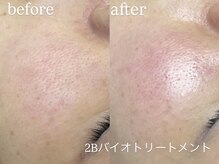 エーアール(ar)/ハーブピーリング/2Bバイオ