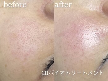 エーアール(ar)/ハーブピーリング/2Bバイオ