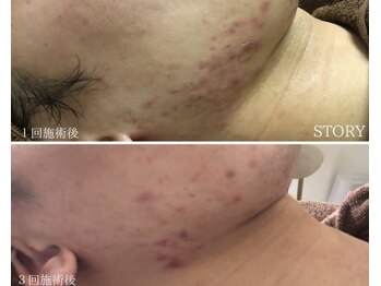 ストーリー 岐阜店(STORY)/ハーブピーリング専門店STORY