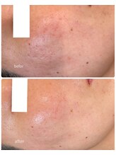 エノアビューティー(ENOA beauty)/ハーブピーリング×光美顔フォト