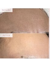 ハナハナ(hanahana)/お肌がグレーっぽい