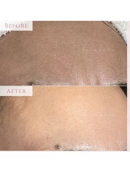 ハナハナ(hanahana)/お肌がグレーっぽい