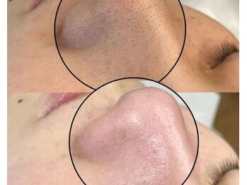 アミナス 渋谷店(AMINAS)/すっきり毛穴洗浄、ツルスベ美肌