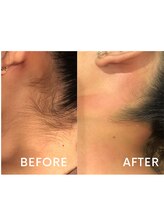 グリン(grin)/ワックス脱毛（2）