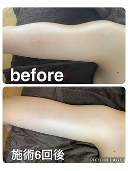 ギンザアール(GINZA R.)/二の腕集中！