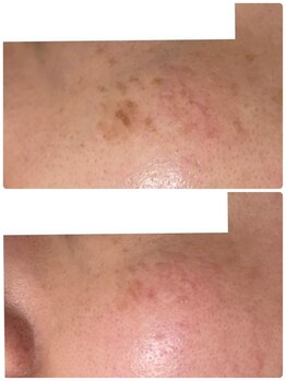 ティエラ(TIERRA)/シミケア4回