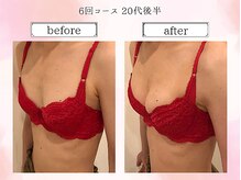 リール 恵比寿店(RIRE)/バストアップ症例【広尾恵比寿】