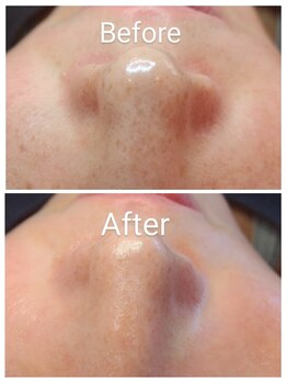 クラリス(Clarice)/鼻のポツポツ・シミ改善には....