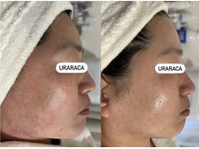 ウララカ(uraraca)/before・after
