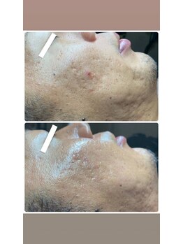 ボニータ(Bonita)/ヒト羊膜臍帯由来幹細胞エステ