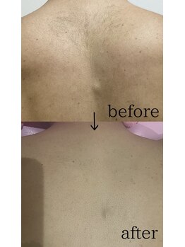 スパイリーア(Spiraea)/脱毛BeforeAfter