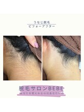ベベ(Bebe)/うなじ脱毛♪