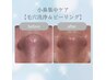 【小鼻集中ケア】毛穴洗浄&ピーリング¥2,500