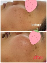ホナ(HONA)/シミにお悩みの方