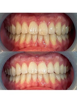 ふぁみーゆ(famille)/セルフホワイトニング♪