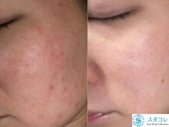 スタコレ スタイルブックコレクションズ 京橋店(Style Book Collections)/ハーブピーリング/ハーブリプロ