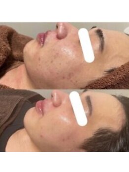 ブプラ 沖縄那覇店(BUPURA)/頭蓋骨矯正×ハーブピーリング