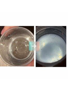 ひなた鍼灸整骨院/毛穴洗浄のビフォーアフター