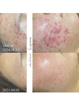 ラ ジェム(la gemme)/ニキビケア