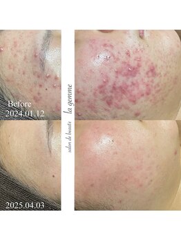 ラ ジェム(la gemme)/ニキビケア