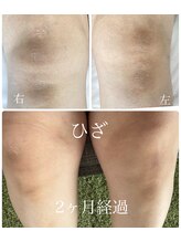 クレーヴ(CREVE)/モニター様経過写真【2ヶ月】
