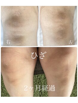 クレーヴ(CREVE)/モニター様経過写真【2ヶ月】