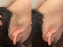 エクシオール 博多店(Exsior.)/うなじ脱毛