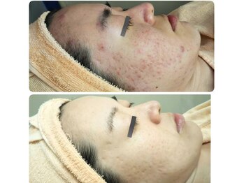 庭夢エステの写真/繰り返す肌荒れ・ニキビ・毛穴悩みに◆憧れの素肌へ肌質改善♪ブライダル前の肌ケアや背中ニキビ悩みにも◎