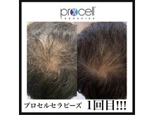 ヒルナム(Heal Nam)/プロセルセラピーズ　~頭皮~