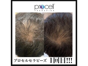 ヒルナム(Heal Nam)/プロセルセラピーズ　~頭皮~