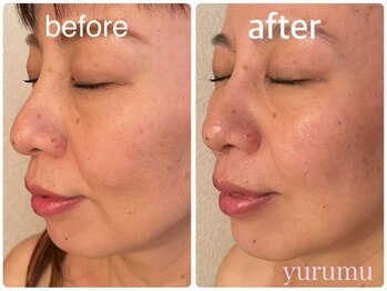 ユルム(Yurumu)/小顔矯正+ヘッドリフト
