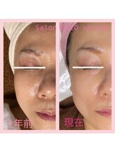 ココ 2号店(CoCo)/ホワイトスノーピール/筋骨小顔