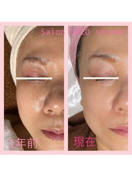 ココ 2号店(CoCo)/ホワイトスノーピール/筋骨小顔